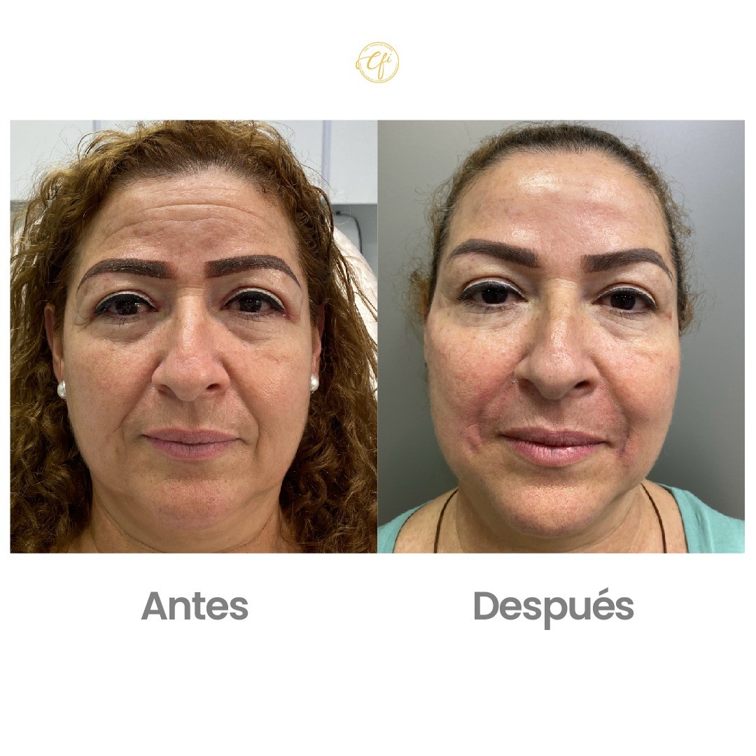 Es Bueno El Botox Para Las Arrugas Sale Online Head Hesge Ch