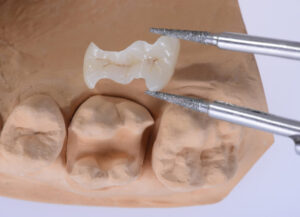 Incrustraciones Dentales tratamientos odontologicos Colombia