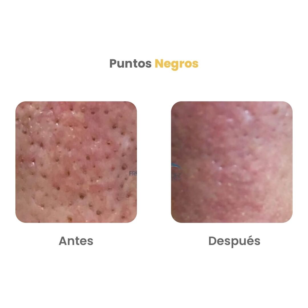 Antes y despues limpieza facial profunda con Hydrash