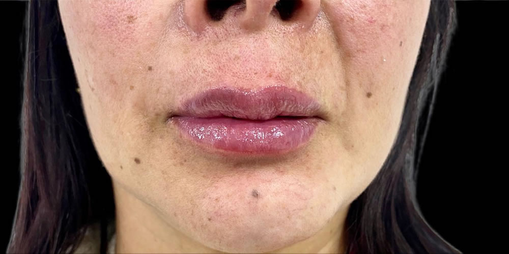 Antes y después aumento y relleno Labios ácido hialurónico