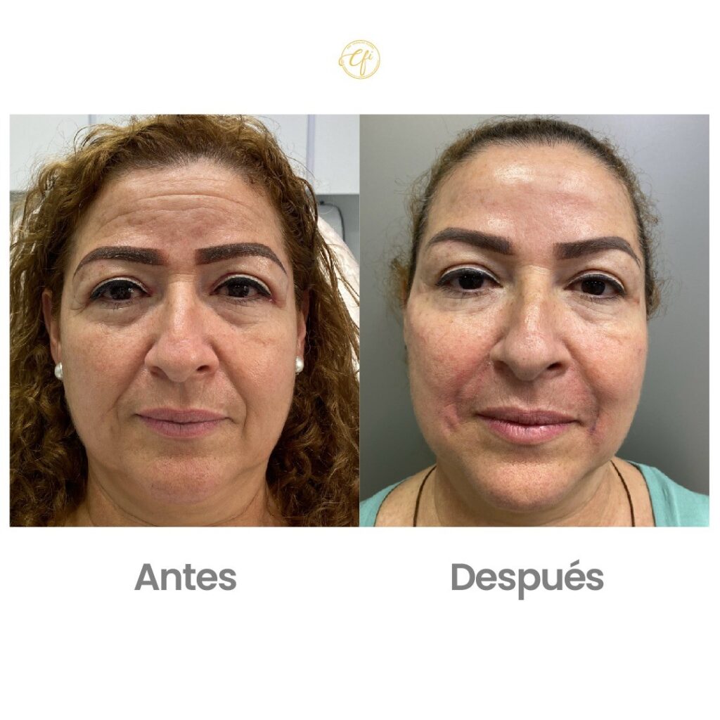 Botox aplicación antes y después