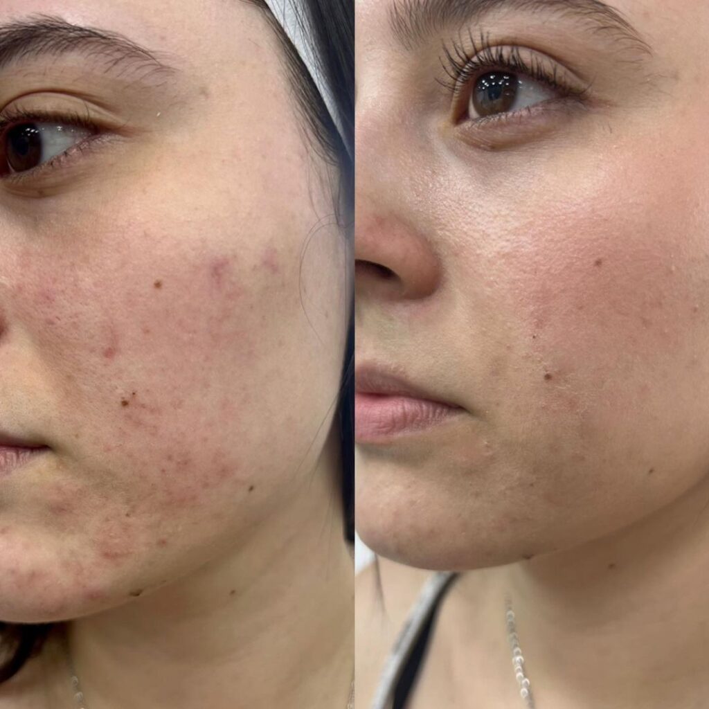 Caso real Antes y después del peeling nanotecnológico y multicomponente