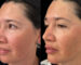 Armonización facial