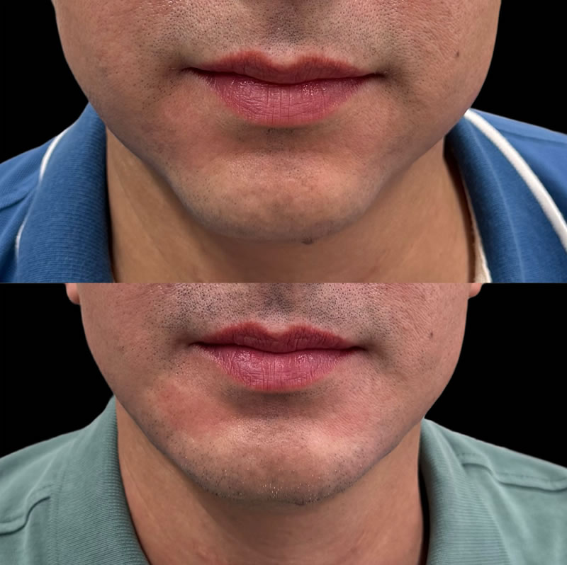 antes después armonización orofacial tercio inferior