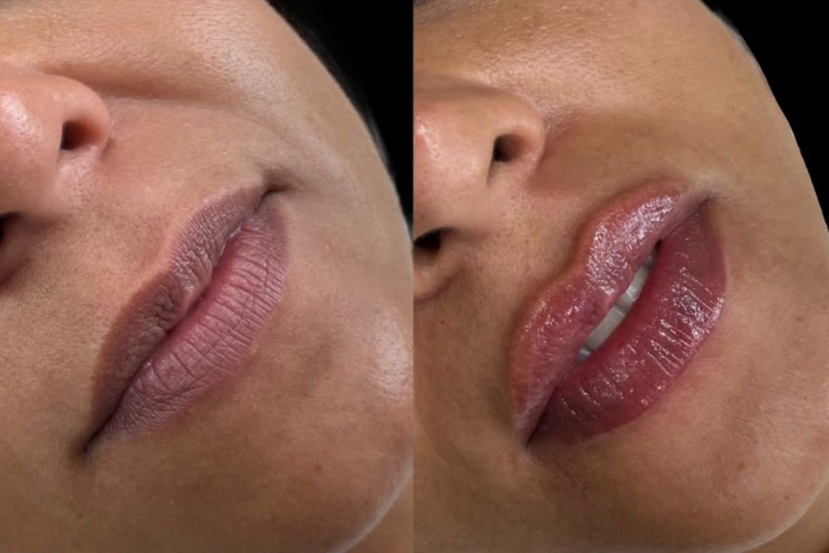 Ácido hialurónico en labios antes y después en Armenia Quindío