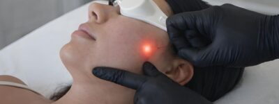 Definición de línea mandibular tras procedimiento de lipopapada estructurada con endoláser