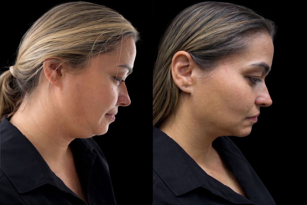 Comparativa perfil facial antes y después de tratamiento con endoláser para eliminar papada y estimular colágeno en cuello y mandíbula.