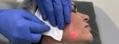 Un profesional de la salud con guantes azules aplica un tratamiento de endoláser en la mandíbula de una paciente de perfil, quien lleva marcas de planificación en el cuello. Una luz roja láser y una gasa están sobre la zona tratada.