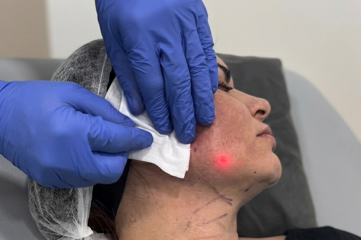 Un profesional de la salud con guantes azules aplica un tratamiento de endoláser en la mandíbula de una paciente de perfil, quien lleva marcas de planificación en el cuello. Una luz roja láser y una gasa están sobre la zona tratada.