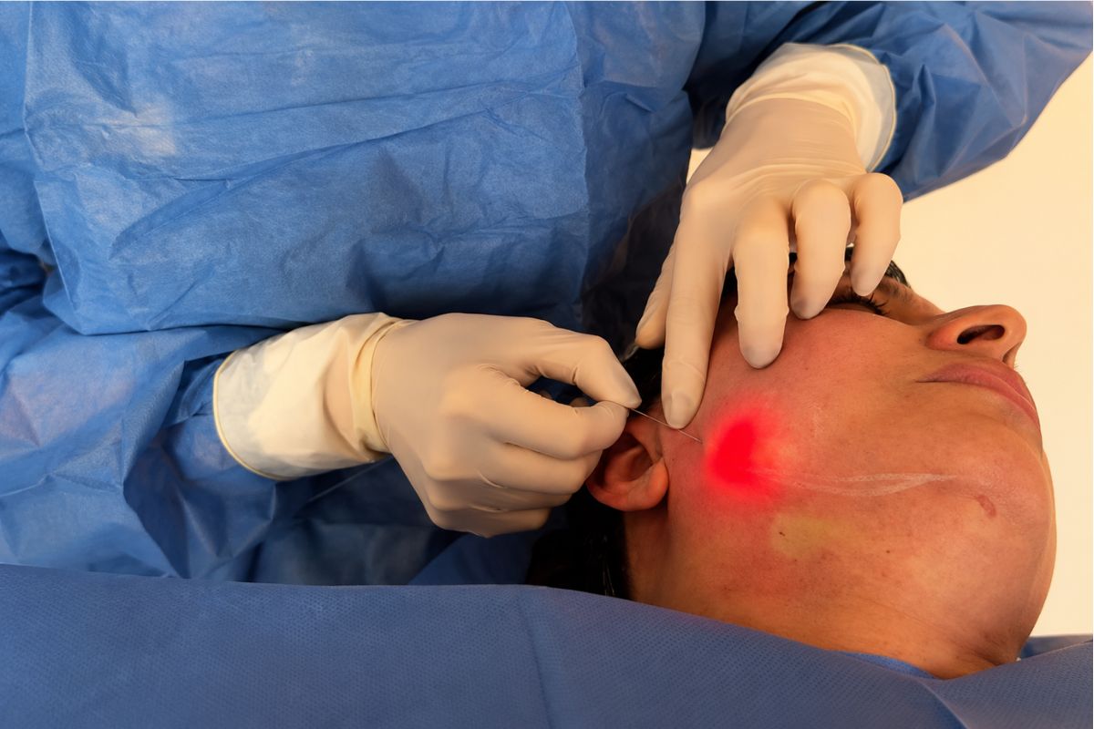 Especialista realizando un procedimiento Endolift facial con fibra óptica para estimular colágeno y mejorar el contorno del rostro.