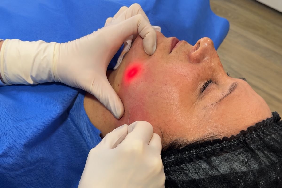 Aplicación de Endolift en la mandíbula para mejorar el contorno facial y reducir la flacidez.