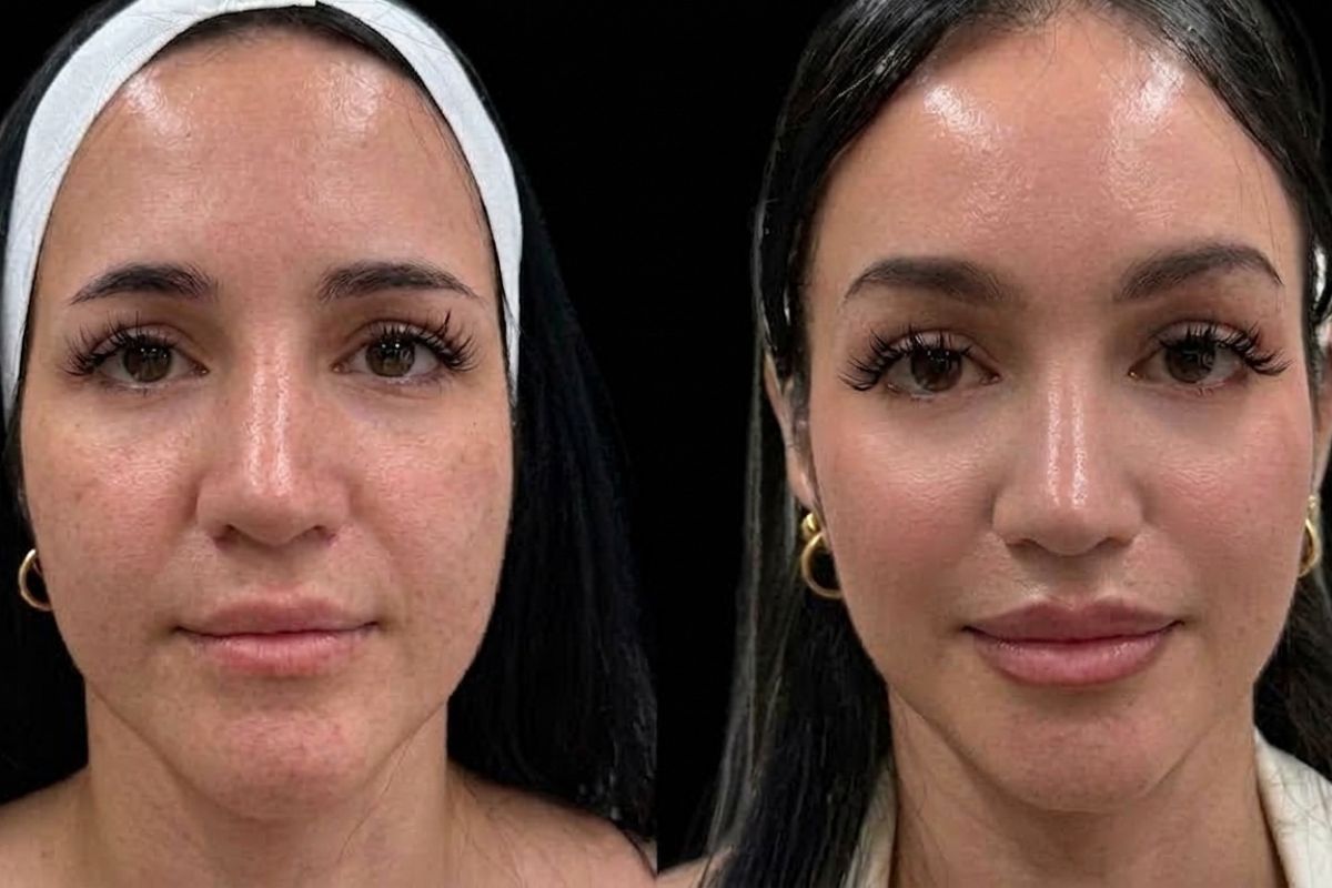 Antes y después de un tratamiento para mejorar la asimetría facial y la armonía del rostro.